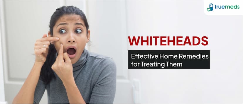 Effective Home Remedies for Treating Whiteheads