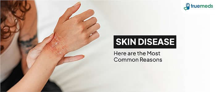 10 Types of Skin Disease