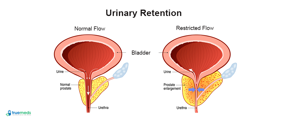 What is Urinary Retention? Understanding Causes, Symptoms, and Treatments