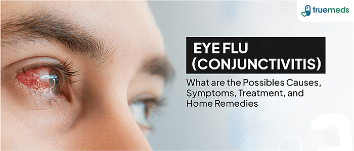 Eye Flu (Conjunctivitis): Causes, Symptoms, Treatment, and Home Remedies