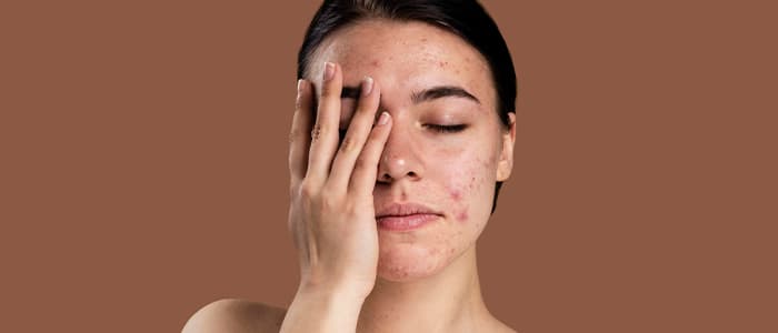 Natural Home Remedy for Skin Allergy