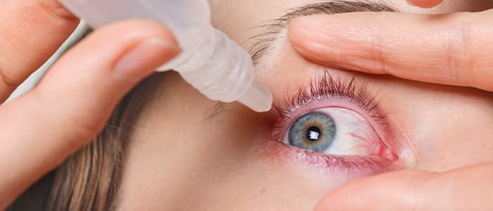 Eye Infection and Irritation: Symptoms, Causes, Home Remedies, Treatment