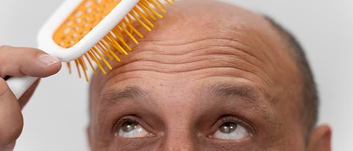 Alopecia Areata Home Remedies You Should Try