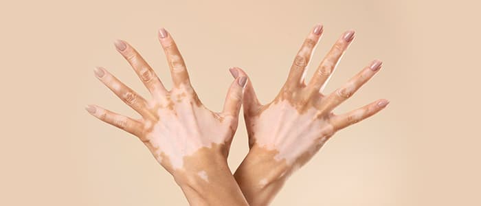 Vitiligo Overview: Diet and Natural Remedies for Vitiligo Cure