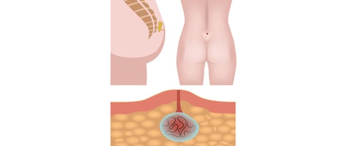 Pilonidal Cyst: Overview, Causes, Symptoms, and Treatment