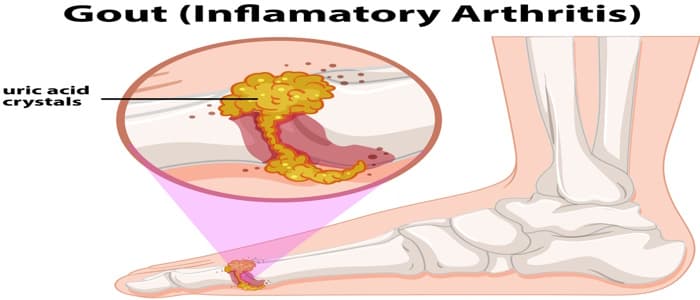 Top 14 Home Remedies for Gout Management and Lifestyle Adjustments