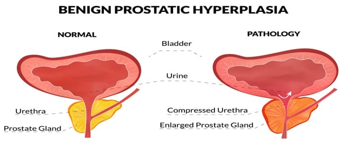 What are the Five Warning Signs of BPH?